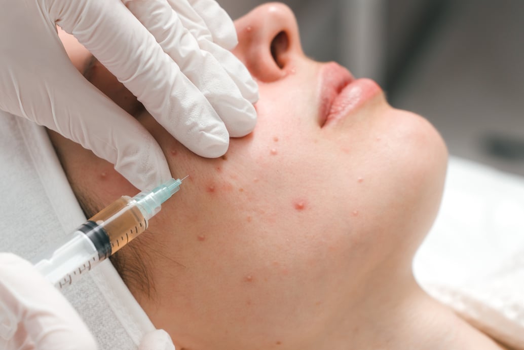 A young woman in a cosmetology clinic, undergoing acne treatment with injections. An effective remedy for acne